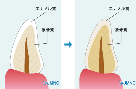 生まれつき、または加齢による黄ばみ