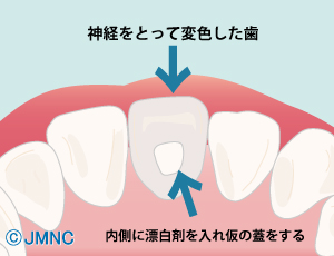 ホワイトニング剤を詰める