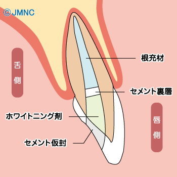 薬剤の交換