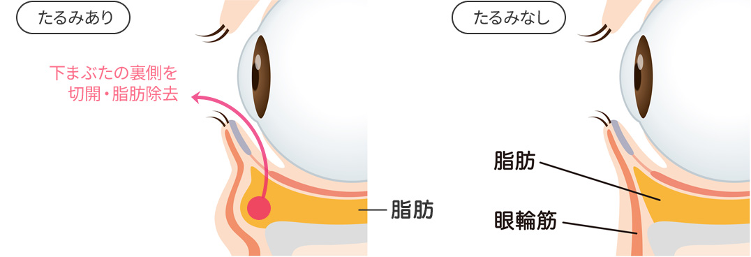 目の下の切らないクマ・たるみ（ふくらみ）取り