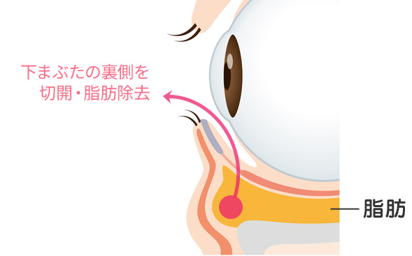 目の下の切らないクマ・たるみ（ふくらみ）取り