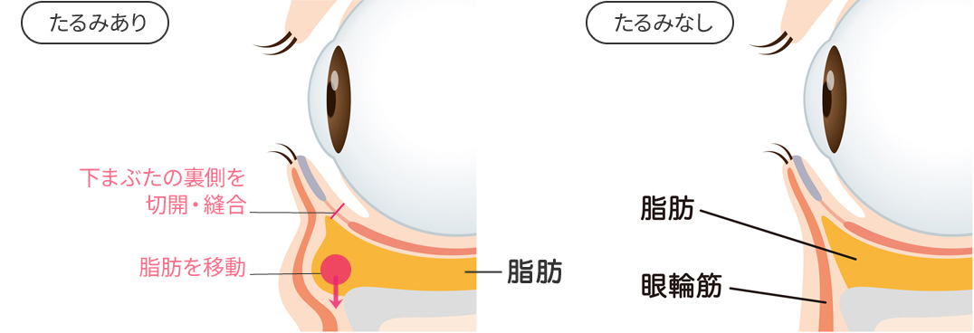 裏ハムラ法