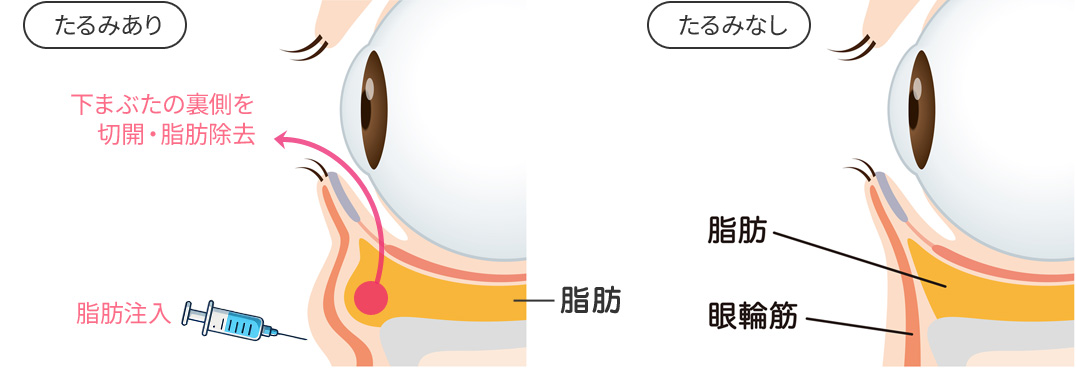 目の下の切らないクマ・たるみ取り（脱脂＋脂肪注入）