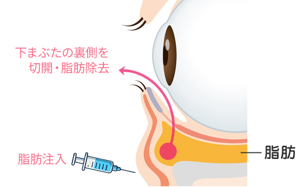 目の下の切らないクマ・たるみ取り（脱脂＋脂肪注入）