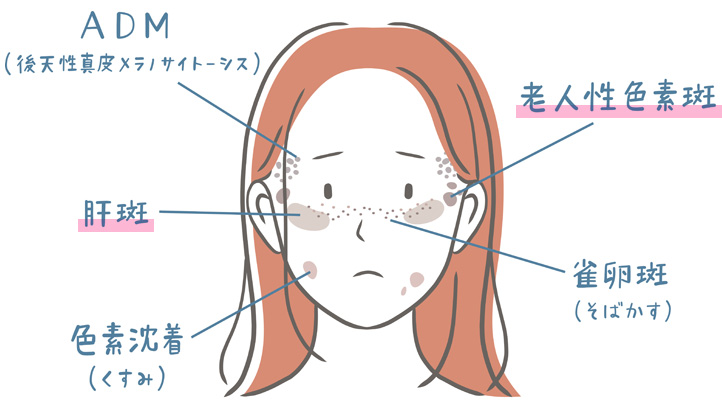 シミ・肝斑におすすめの施術は？