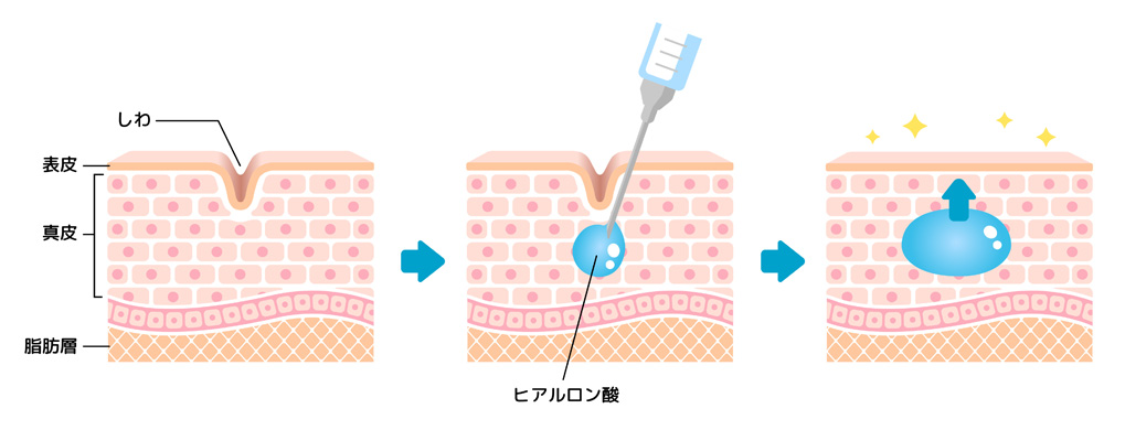 ヒアルロン酸注射（注入）