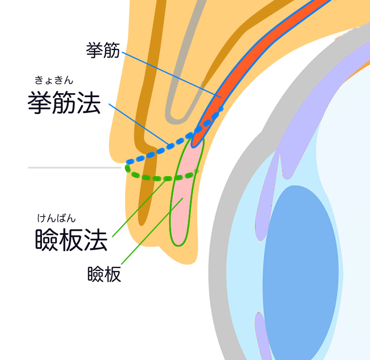 ①埋没糸をかける場所：挙筋法（きょきんほう）・瞼板法（けんばんほう）の違い