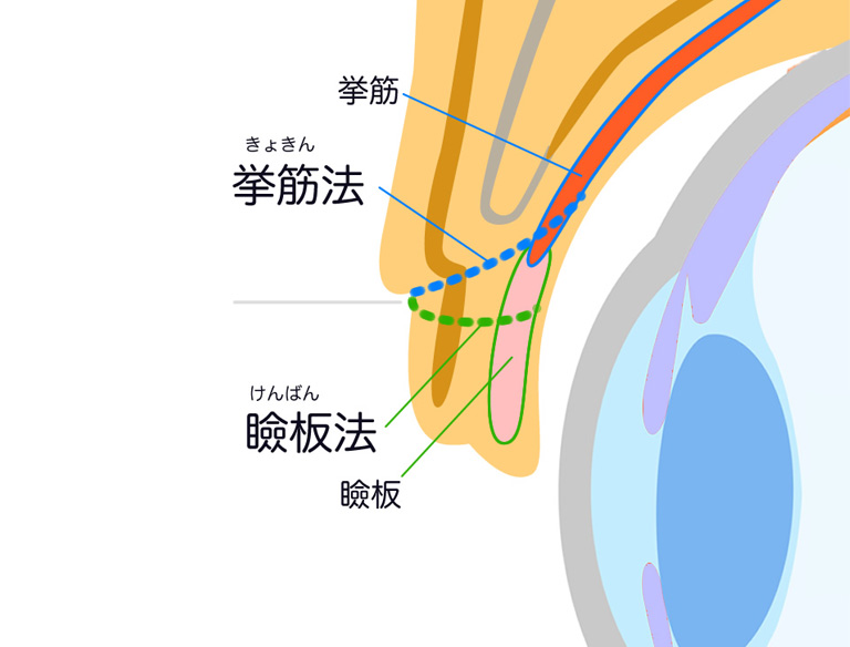 ①埋没糸をかける場所：挙筋法（きょきんほう）・瞼板法（けんばんほう）の違い