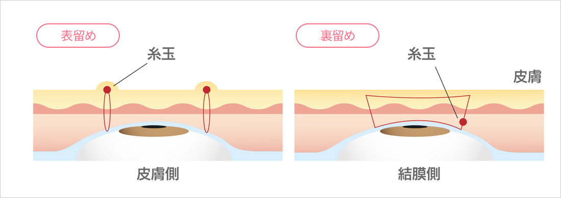 ③まぶたに傷跡がつくか：表留め・裏留めの違い